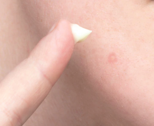 Sulfur Spot Treatment